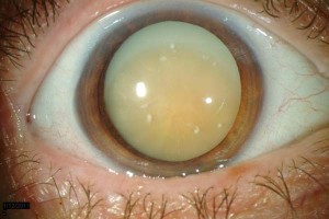 Morgagnian-Cataract-1sm         